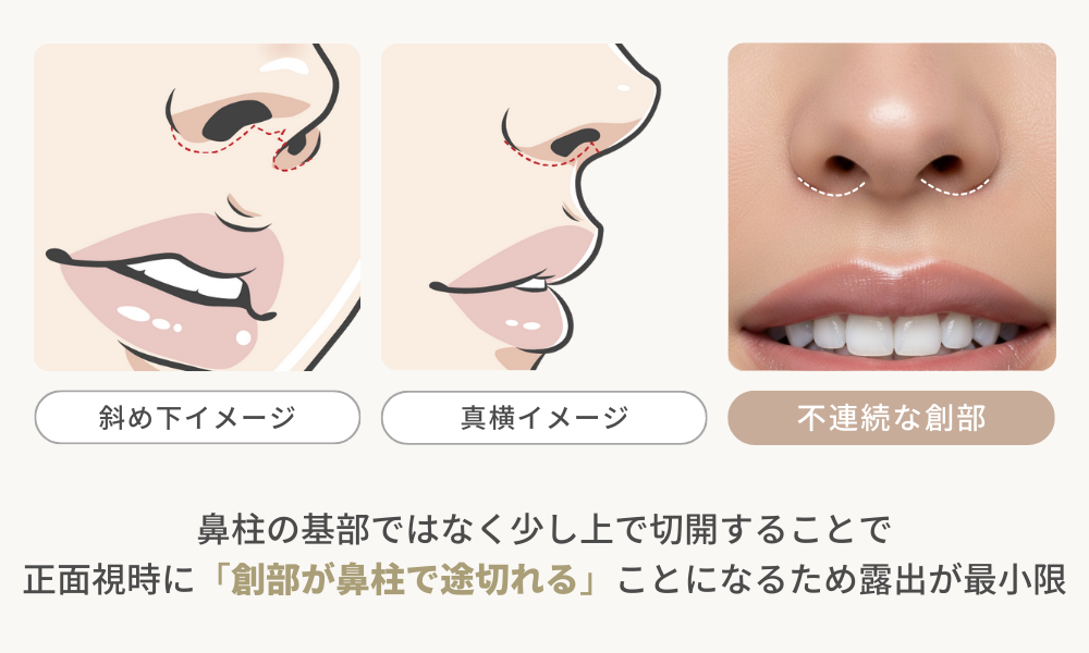 鼻柱切開人中短縮の創部の見え方イメージ