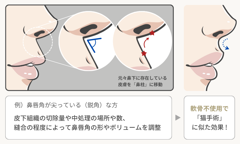 鼻柱切開人中短縮による鼻唇角形成(猫手術)効果の解説