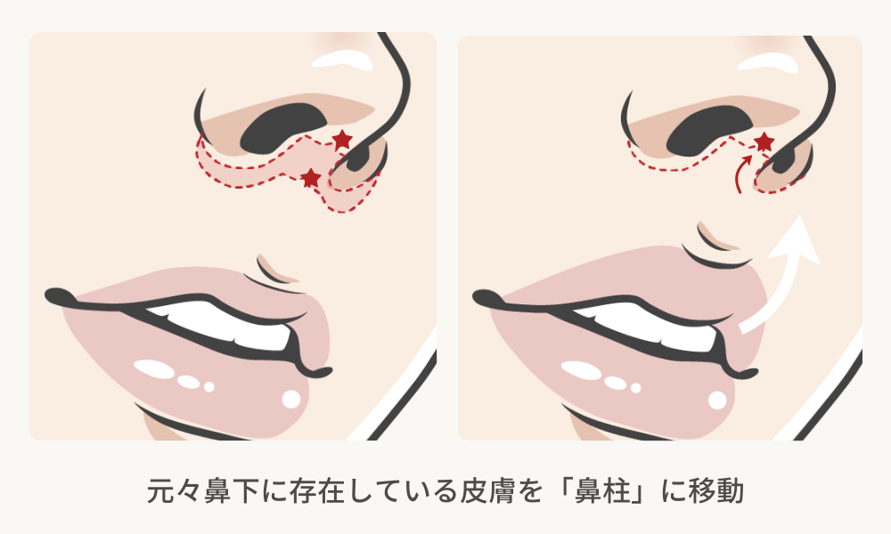 鼻柱切開人中短縮の解説