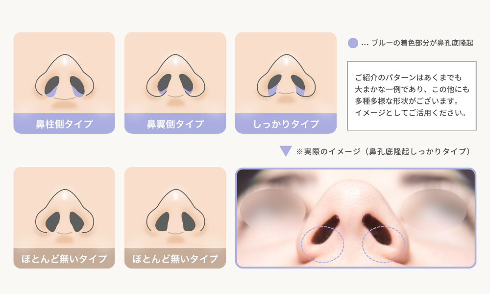 「鼻孔底隆起」の個人差と形の種類一例イメージ