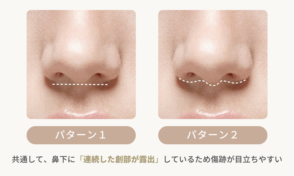 一般的な人中短縮の創部露出範囲