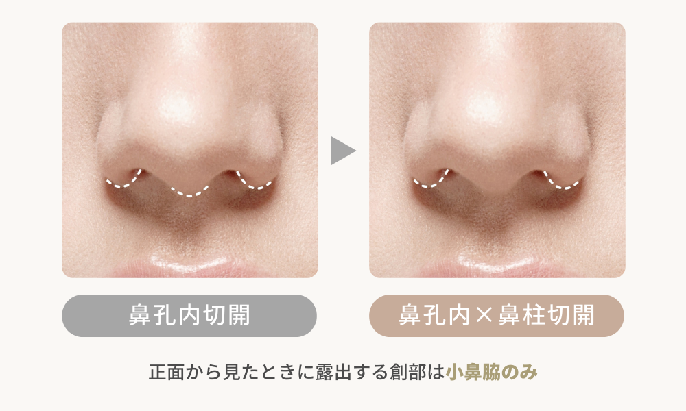 人中短縮｜ミックス法（鼻柱切開＋鼻孔内切開）の創部の見え方