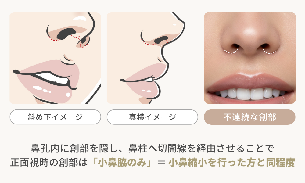 人中短縮｜ミックス法（鼻柱切開＋鼻孔内切開）による創部の見え方イメージ