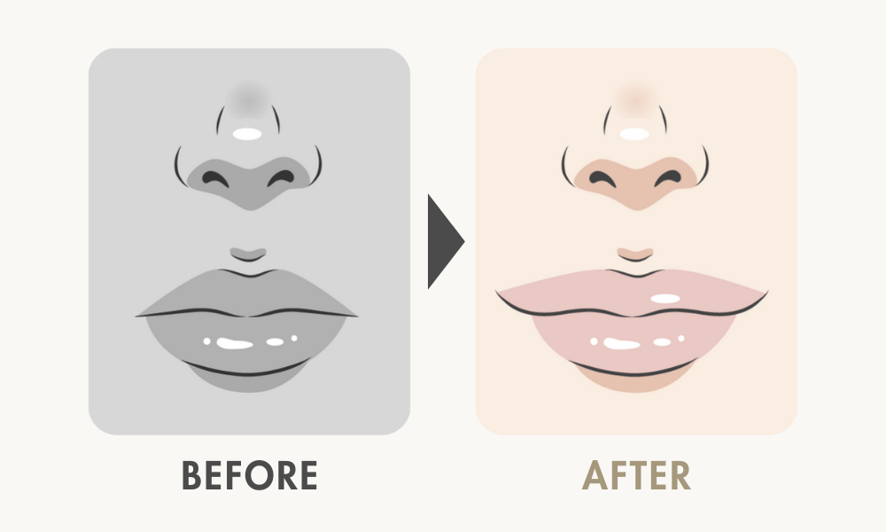 口角挙上と外側人中短縮の併用デザインパターン