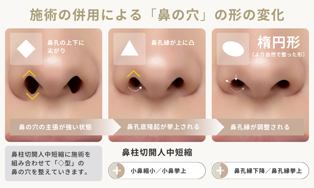 「鼻柱切開法人中短縮、小鼻形成、鼻孔縁形成」施術の組み合わせによる鼻の穴の見え方の変化