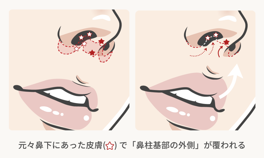 人中短縮｜ミックス法（鼻柱切開＋鼻孔内切開）解説