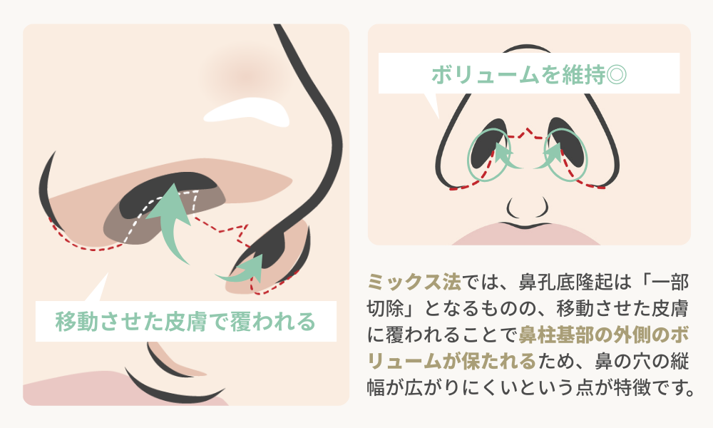 人中短縮｜ミックス法（鼻柱切開＋鼻孔内切開）解説