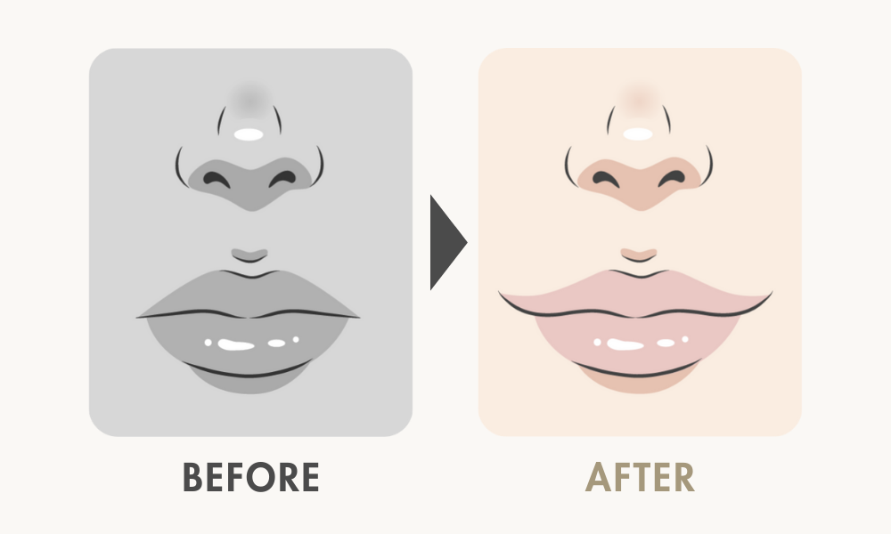 口角挙上と外側人中短縮の併用デザインパターン