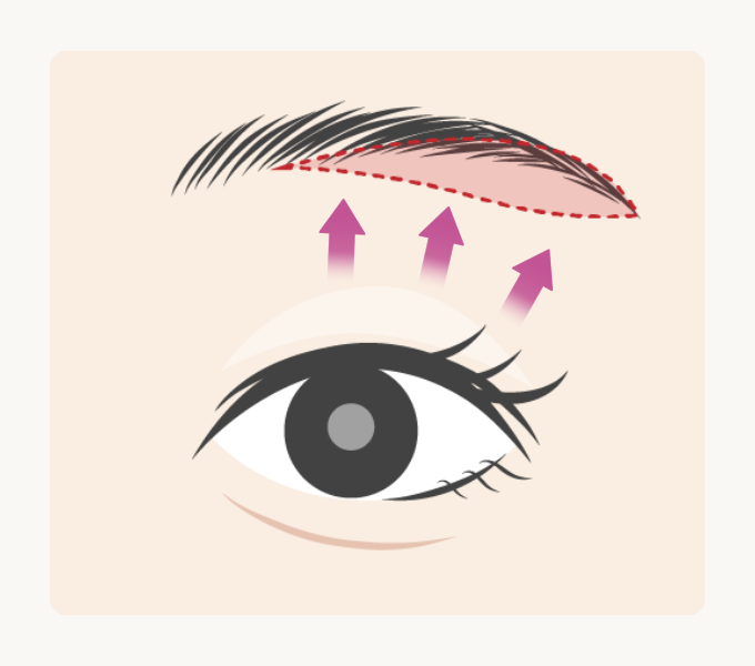 一般的名眉下切開デザインイメージ