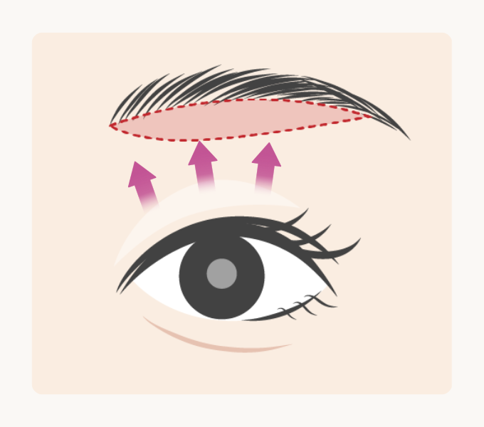 上瞼の内側の重さが気になる方に適した眉下切開デザインイメージ