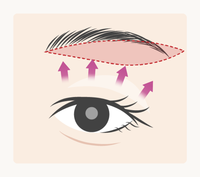 まぶた全体を大きく引き上げる眉下切開デザインイメージ