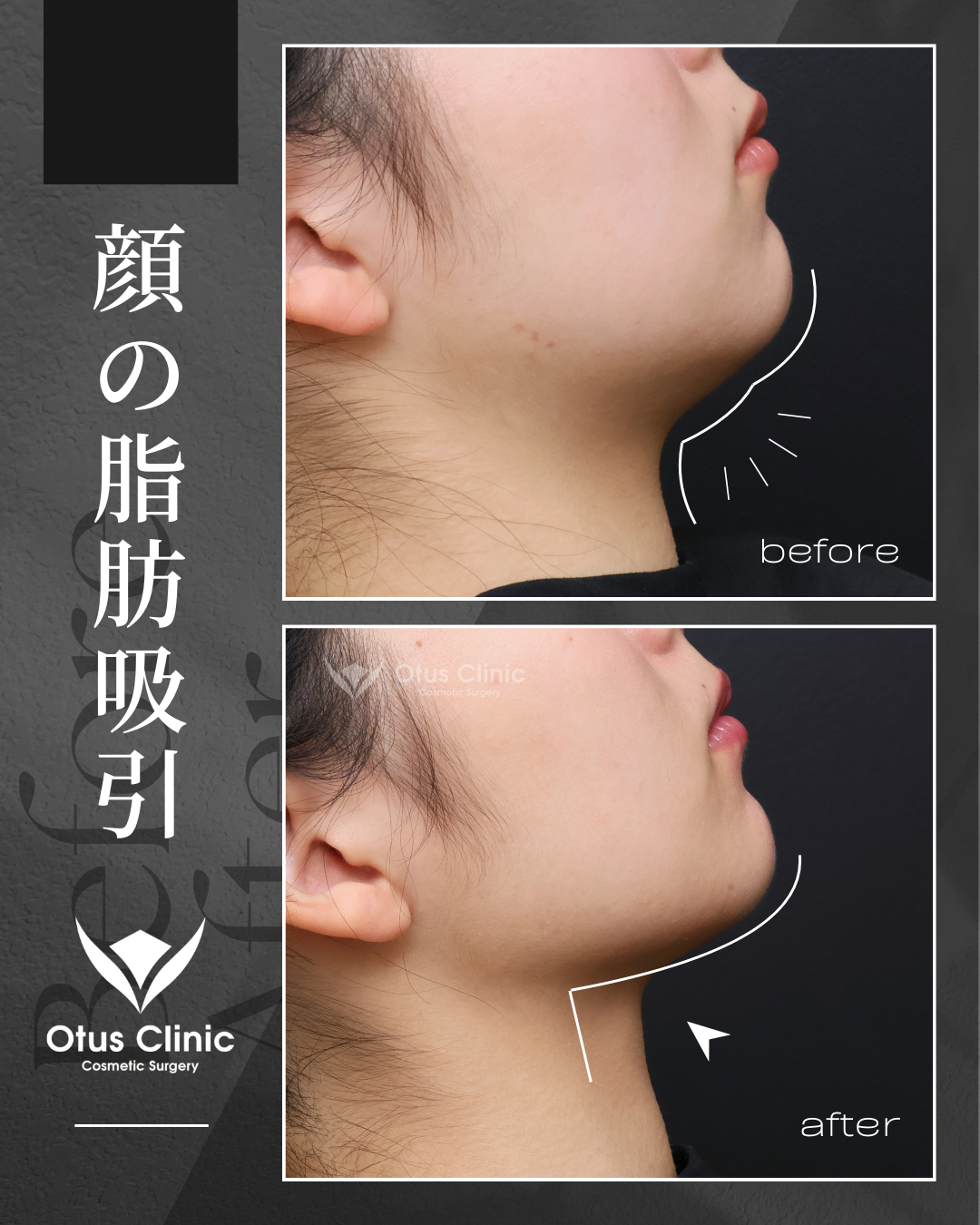 頬顎下脂肪吸引・ジョールファット除去・VOVリフトプレミアム
