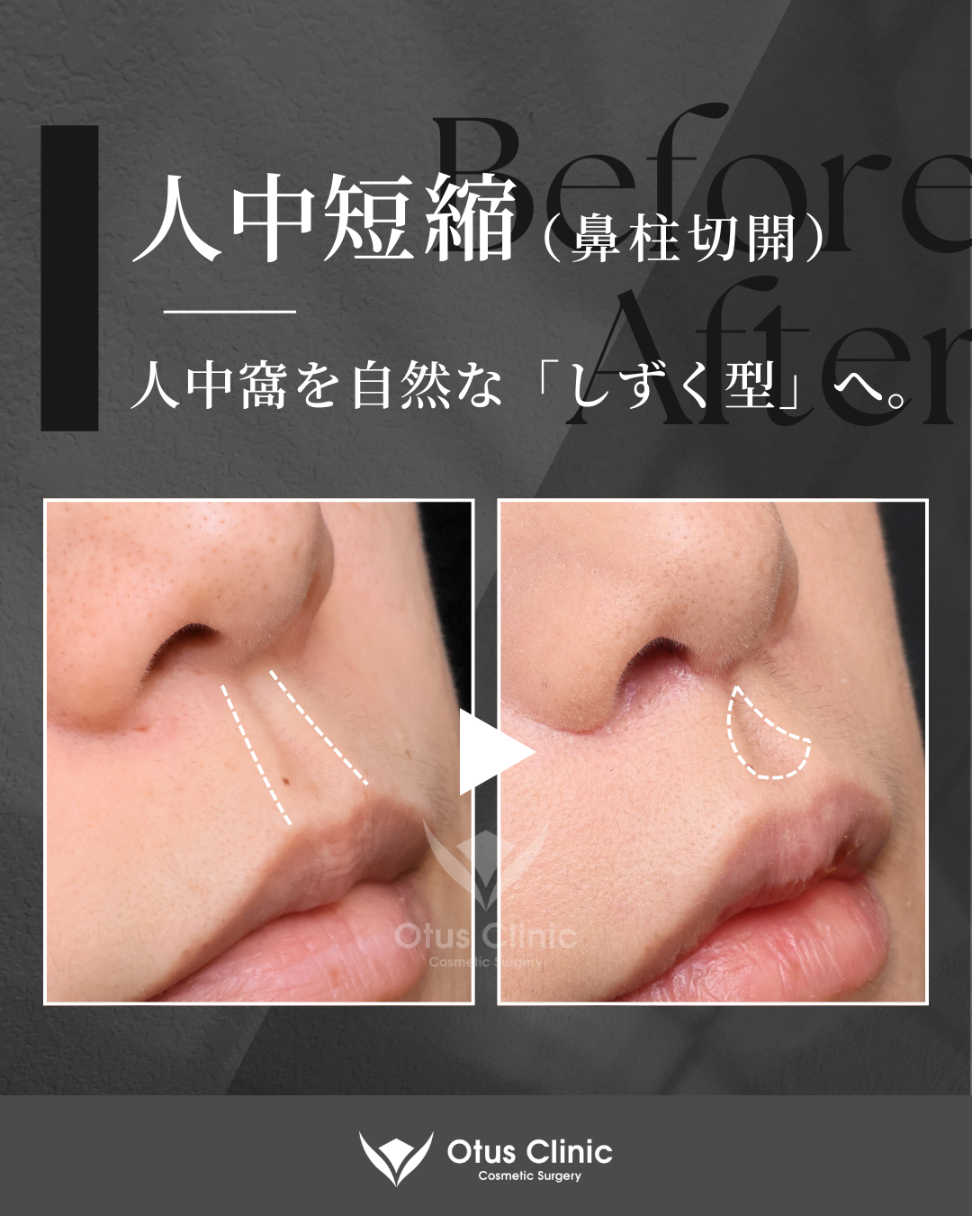 鼻柱切開人中短縮・鼻翼縮小・鼻翼挙上・貴族組織移植