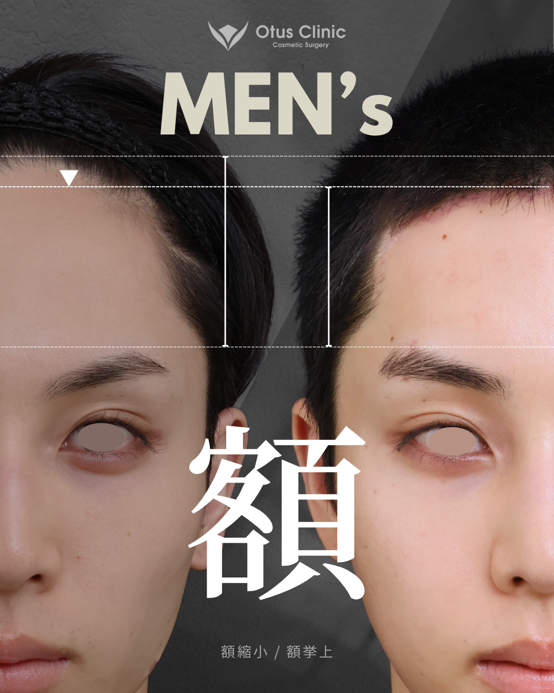 額縮小・額挙上