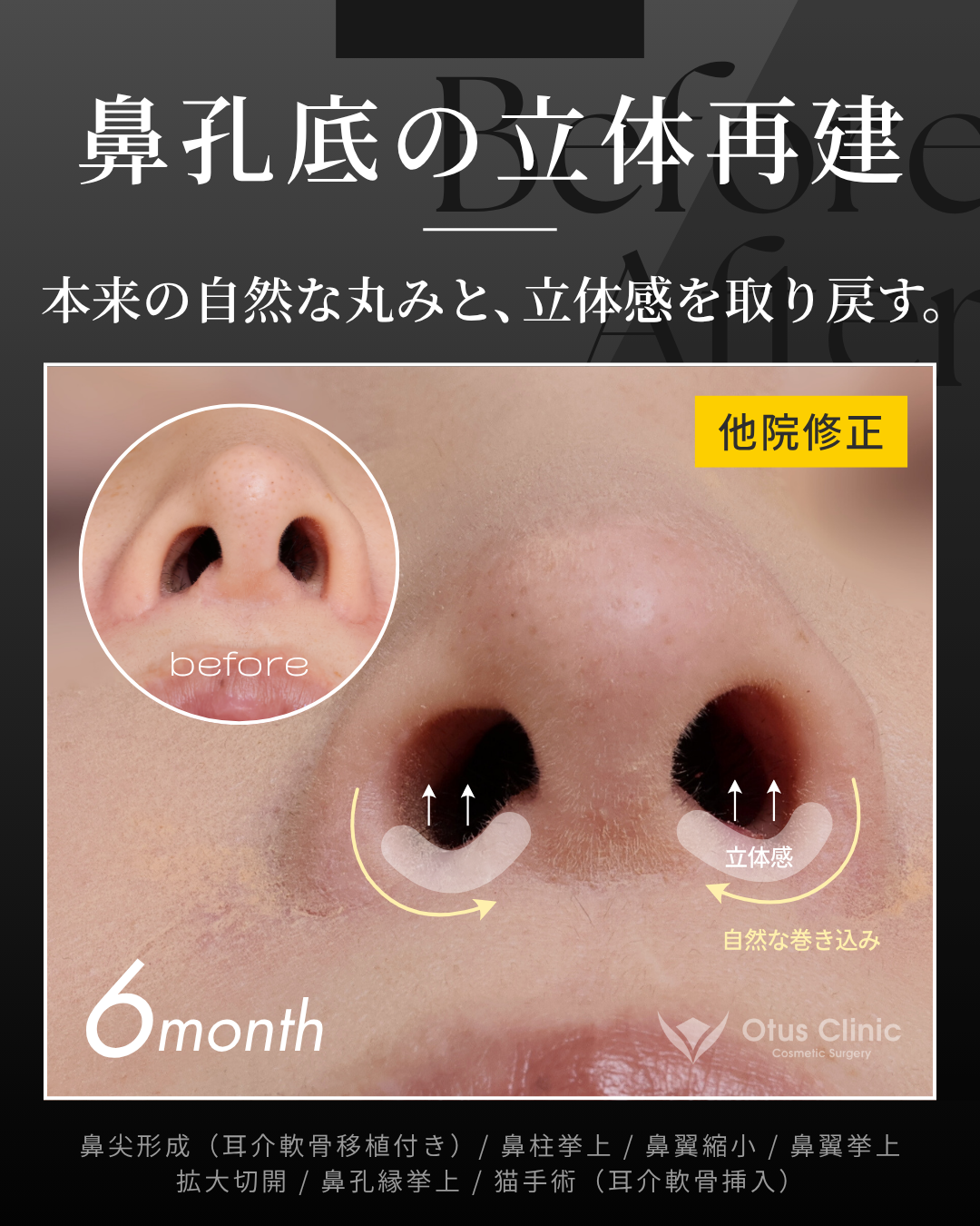 鼻尖形成（耳介軟骨移植付き）・鼻柱挙上・鼻翼縮小・鼻翼挙上・拡大切開・鼻孔縁挙上・猫手術（耳介軟骨挿入）