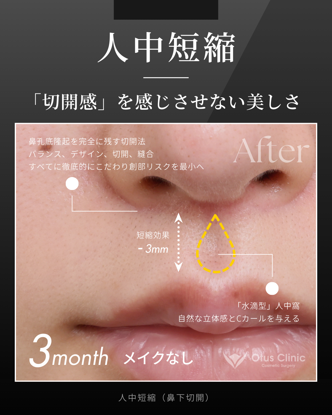 人中短縮(鼻下切開)