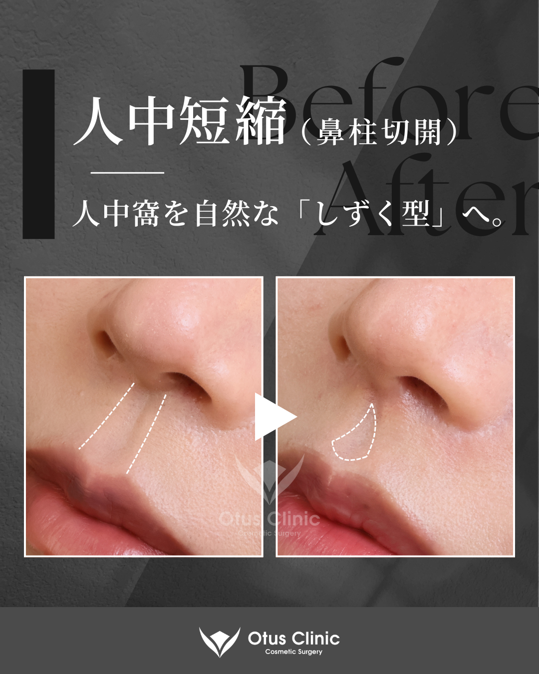 鼻柱切開人中短縮・鼻翼縮小・鼻翼挙上