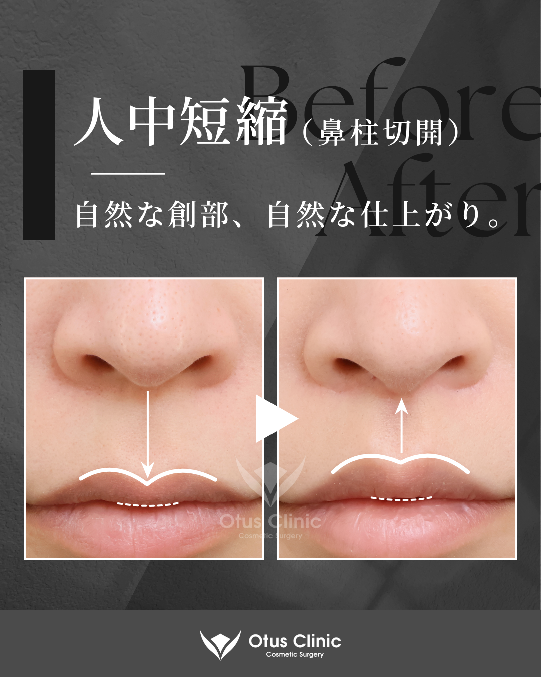 鼻柱切開人中短縮・鼻翼縮小・鼻翼挙上