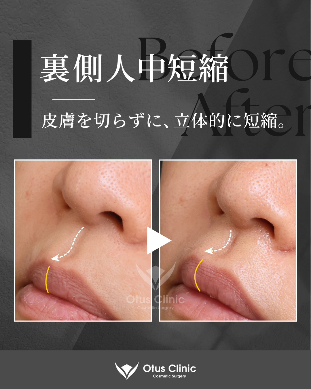 裏側人中短縮（切らない人中短縮）