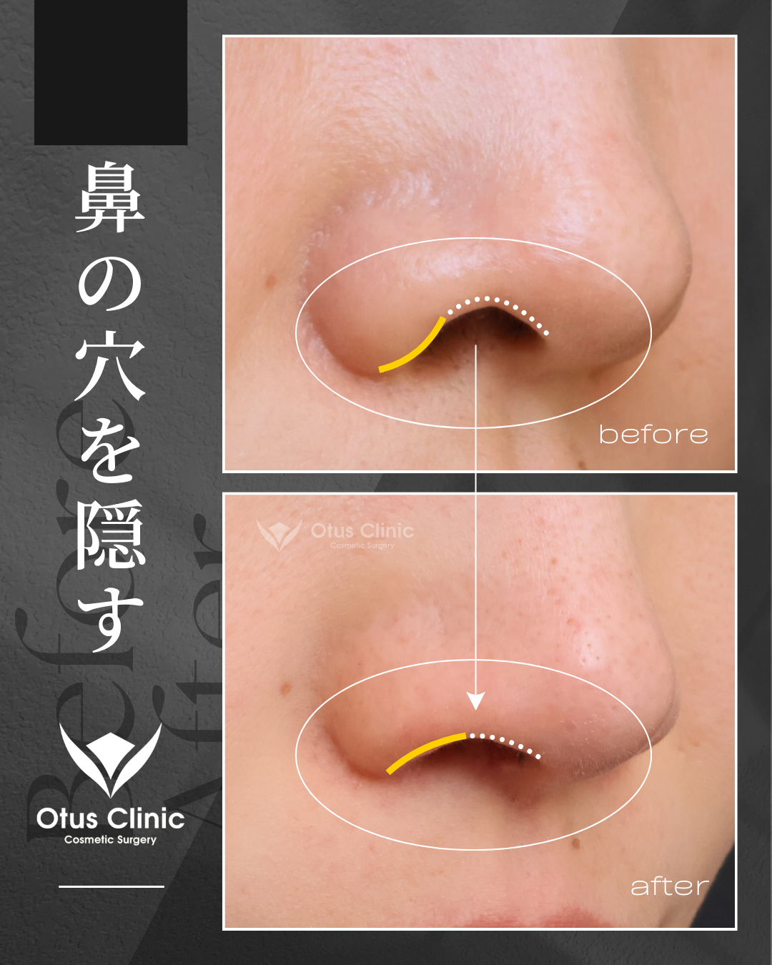 鼻孔縁下降・鼻孔縁挙上・鼻柱下降・口角挙上・口唇縮小