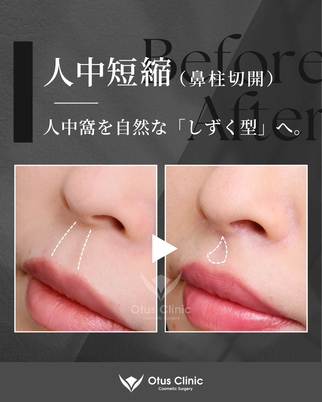 鼻柱切開人中短縮・貴族組織移植