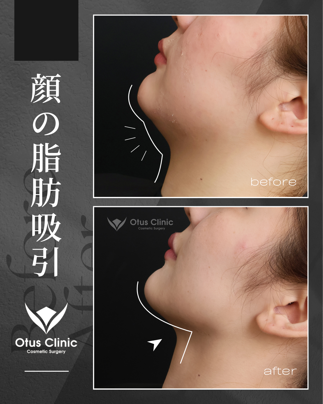 頬顎下脂肪吸引・VOVリフトプレミアム４本
