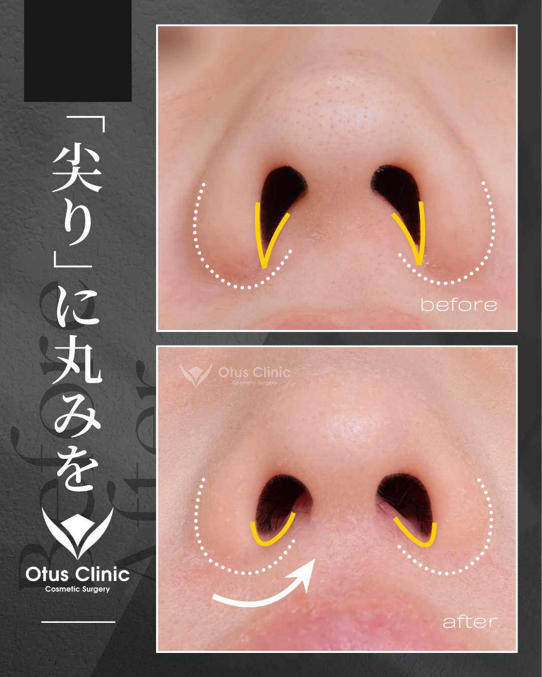 鼻柱切開人中短縮・鼻翼縮小・鼻翼挙上