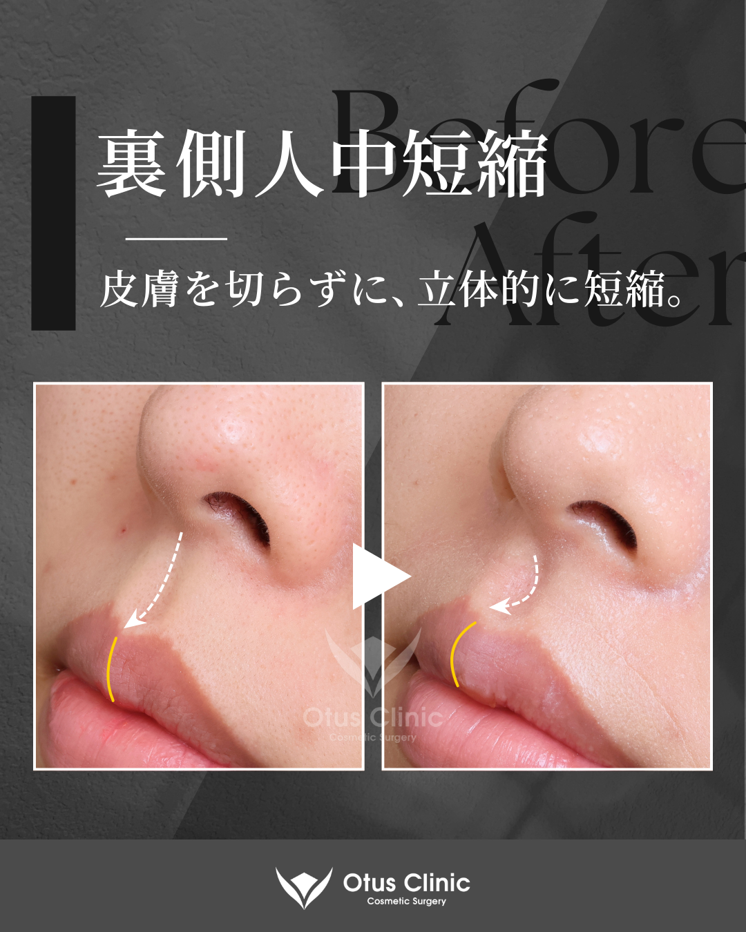 裏側人中短縮（切らない人中短縮）