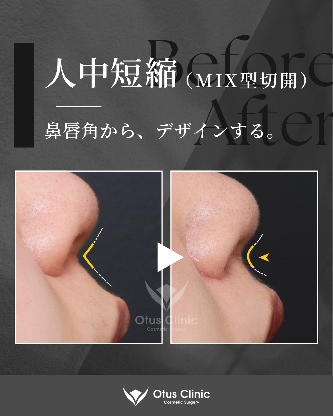 人中短縮(鼻柱切開×鼻腔内切開)