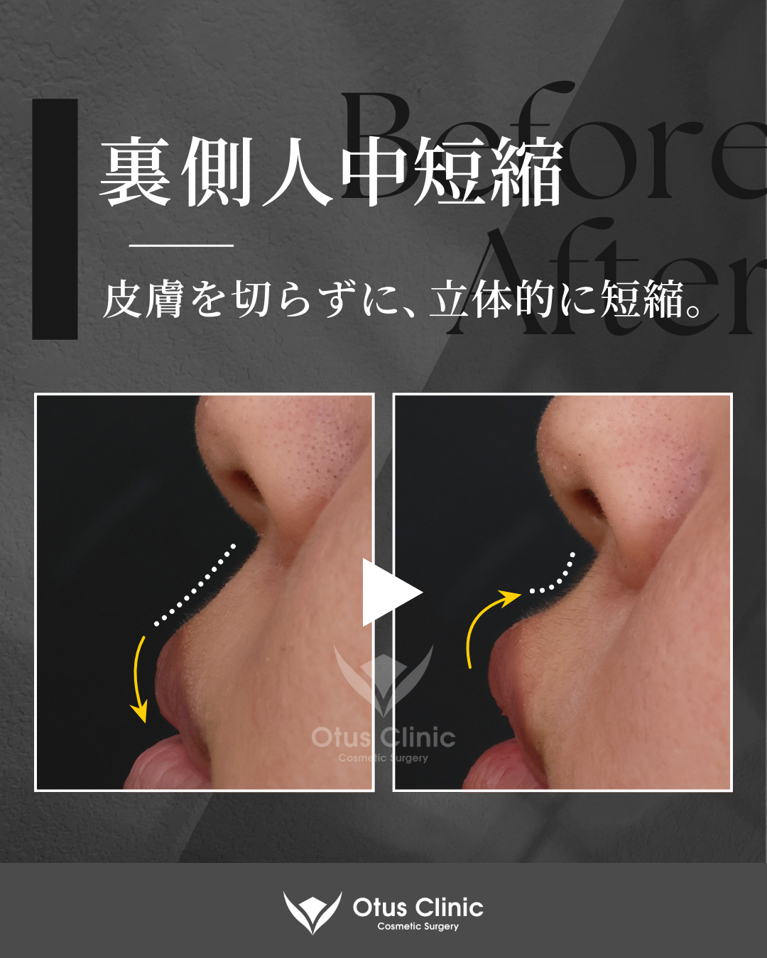 裏側人中短縮（切らない人中短縮）