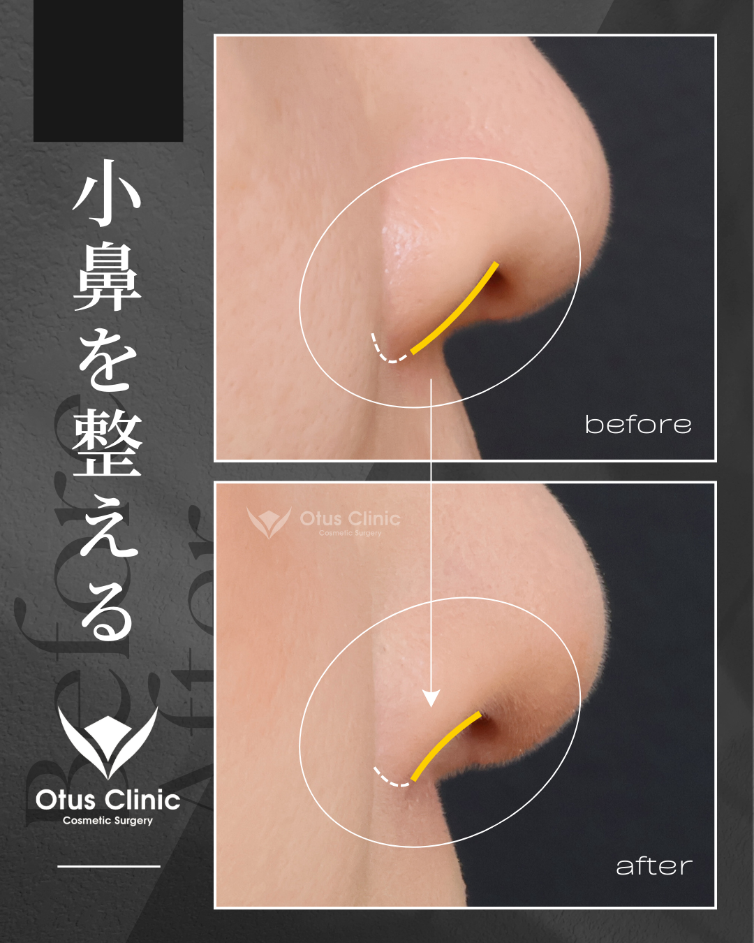 鼻翼縮小・鼻翼挙上・鼻孔縁挙上
