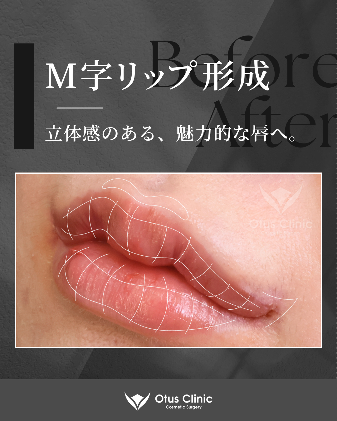 M字リップ・口角挙上 (全層法)・外側人中短縮