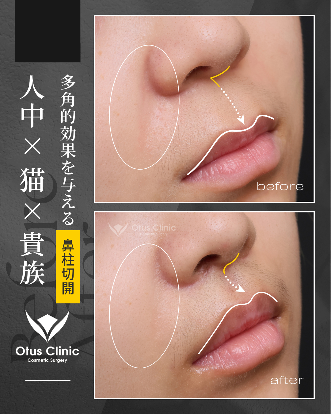 鼻柱切開人中短縮・貴族組織移植