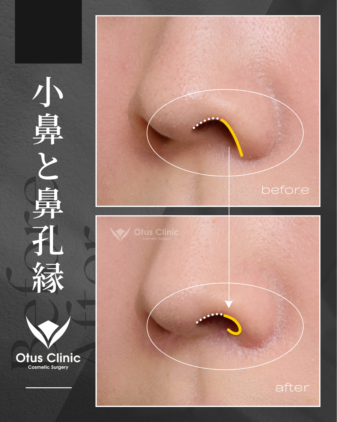 鼻翼縮小・鼻翼挙上・鼻孔縁挙上