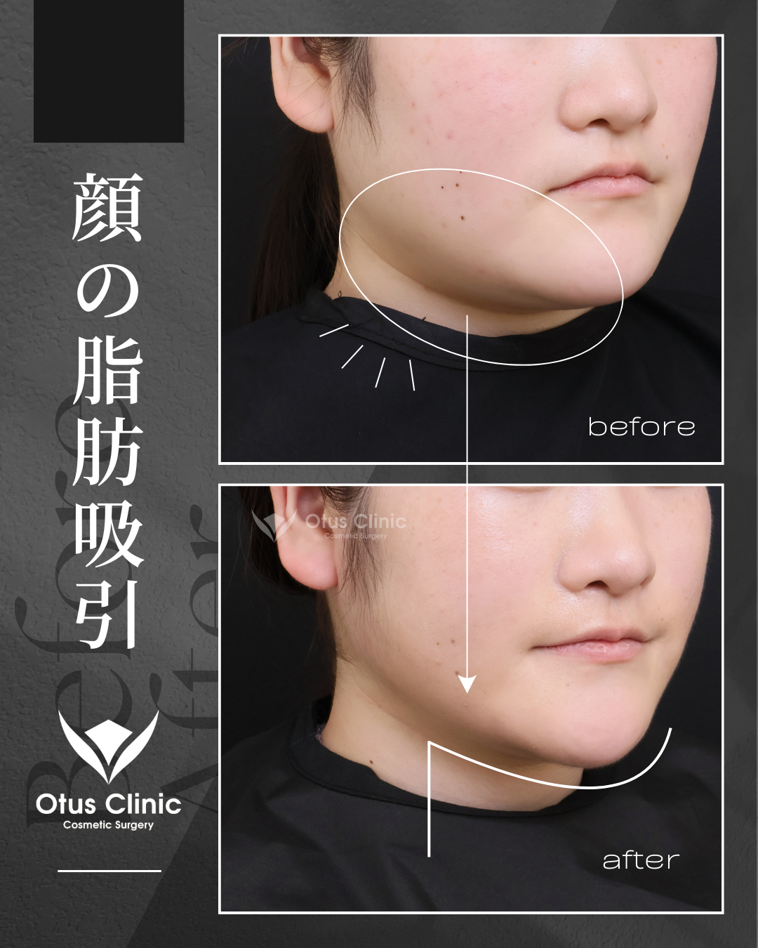頬顎下脂肪吸引 ・ジョールファット除去 ・ エラBTX