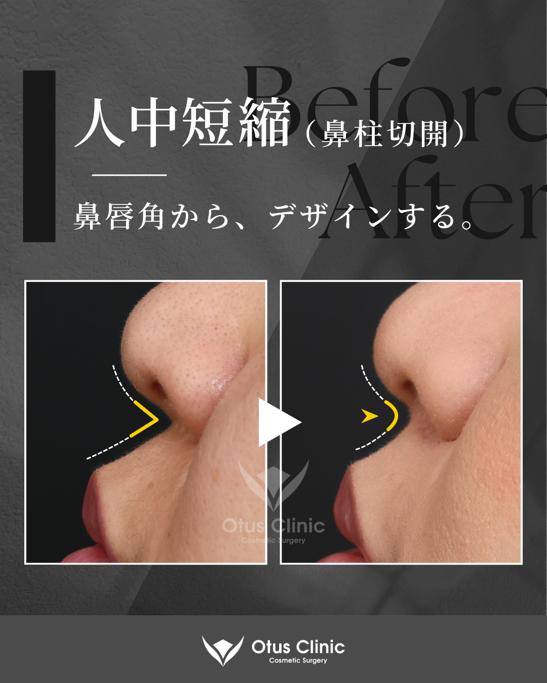 鼻柱切開人中短縮・ 貴族組織移植