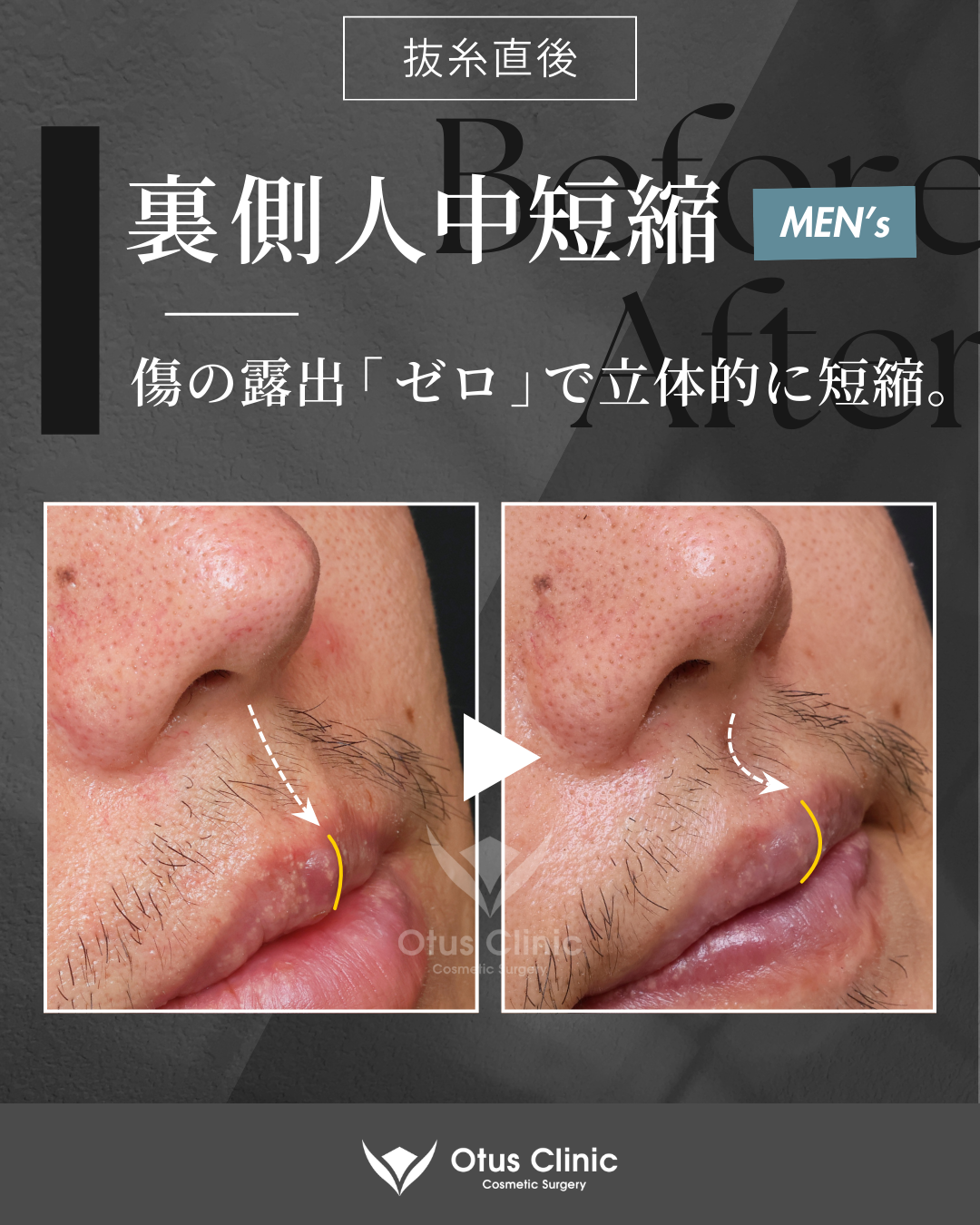 裏側人中短縮（切らない人中短縮）