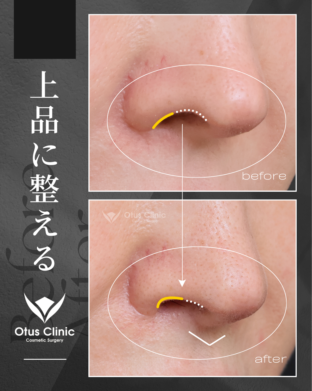 人中短縮（鼻柱切開×鼻腔内切開）・鼻翼縮小・鼻翼挙上・鼻孔縁挙上・鼻孔縁下降・貴族組織移植