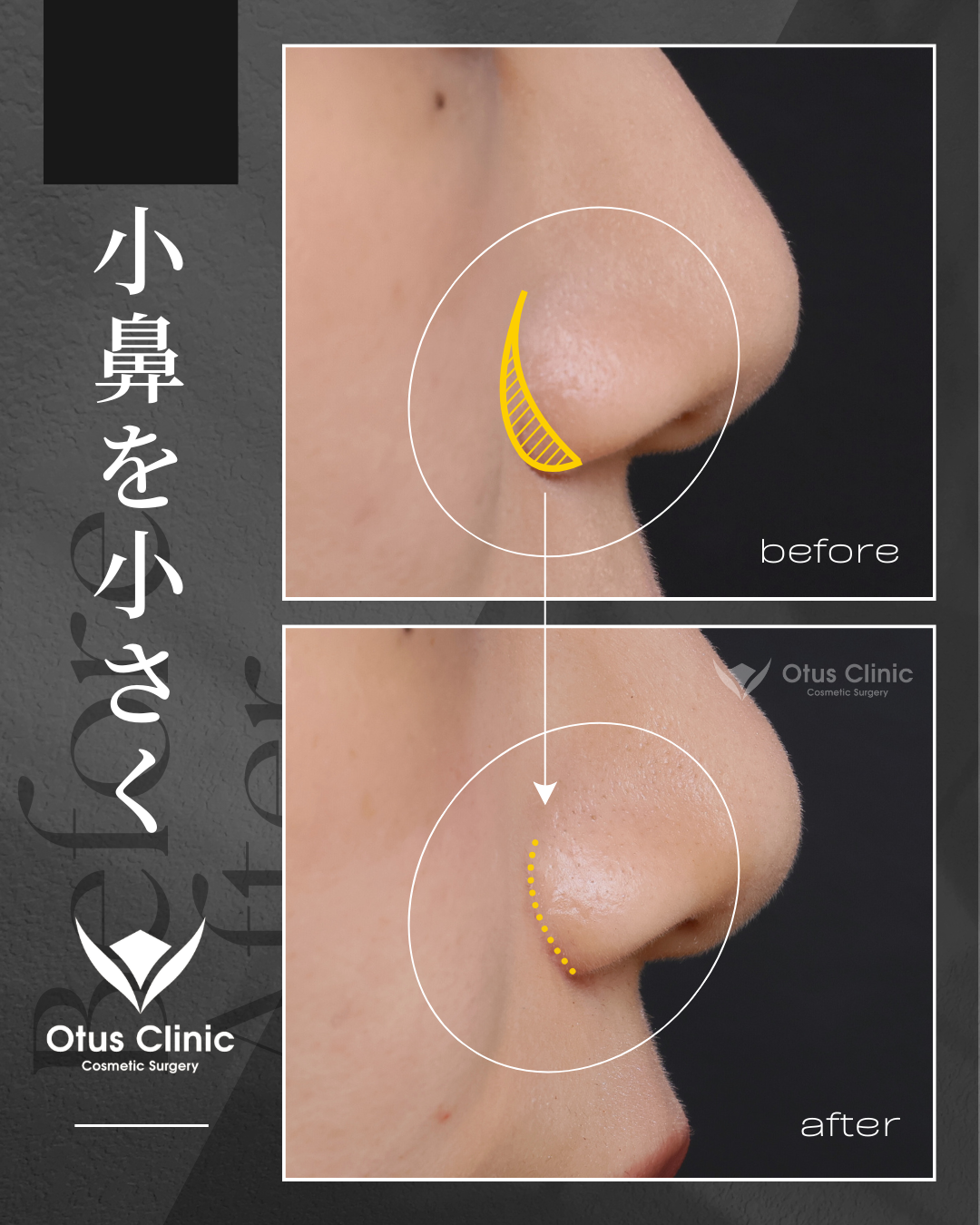 鼻翼縮小（小鼻縮小）｜外側法