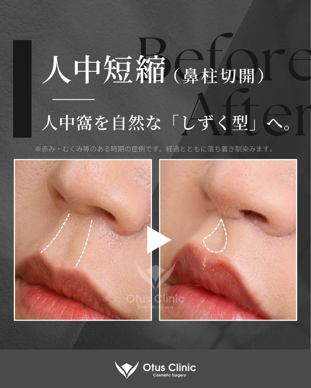 鼻柱切開人中短縮・貴族組織移植