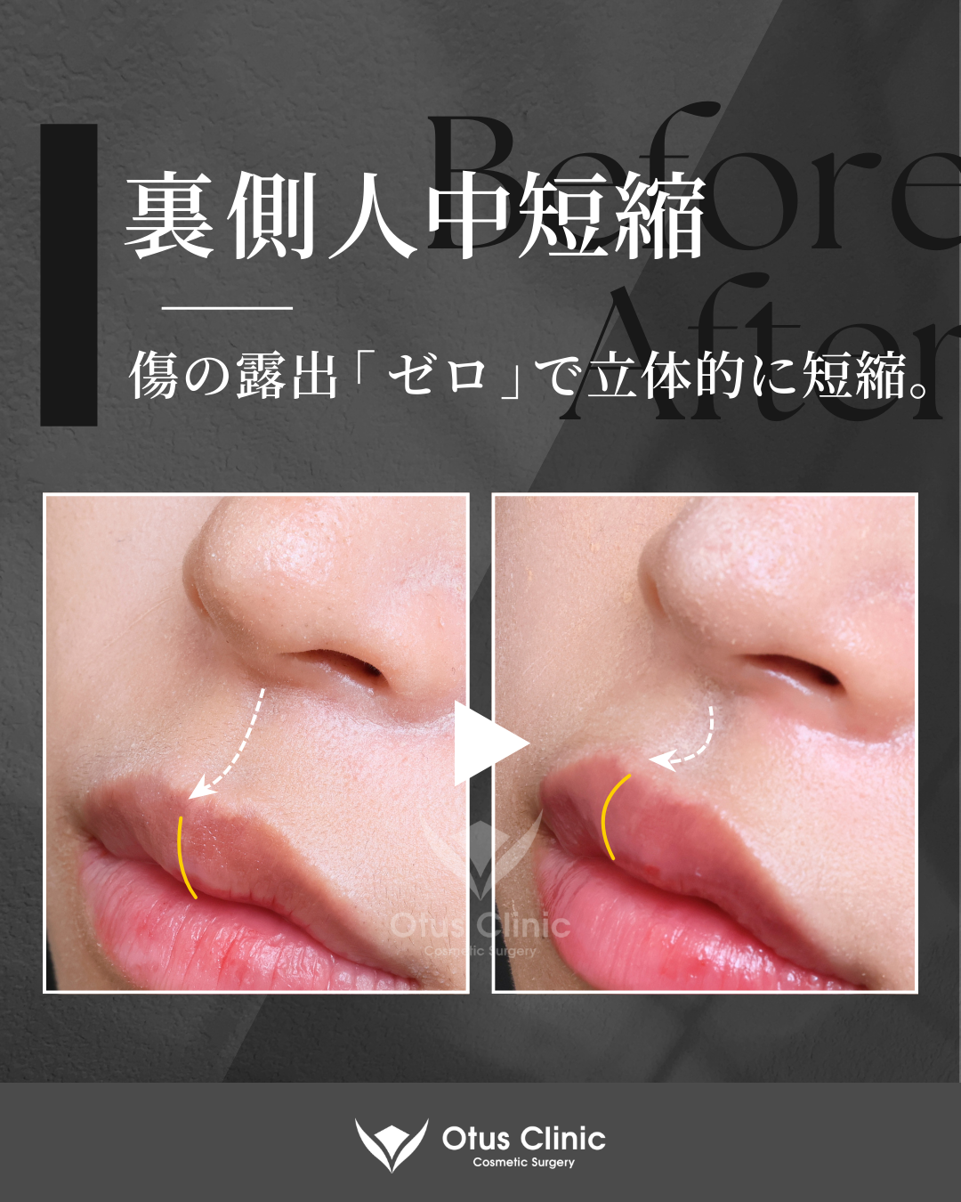 裏側人中短縮（切らない人中短縮）