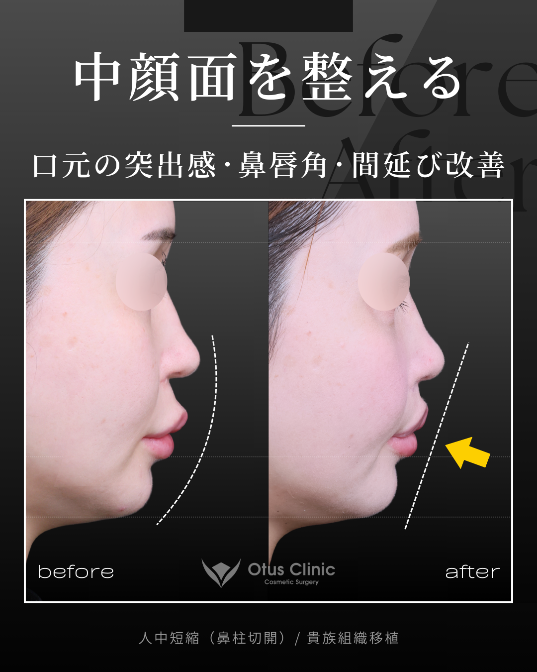 鼻柱切開人中短縮・貴族組織移植