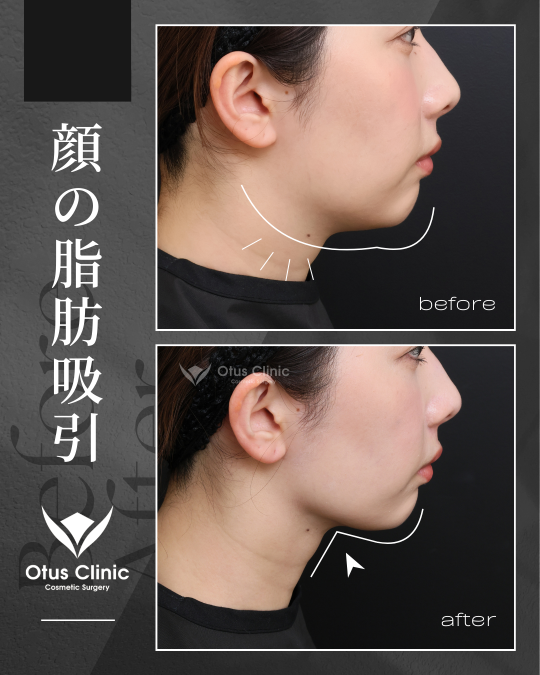 頬顎下脂肪吸引 ・ジョールファット除去 ・VOVリフトプレミアム