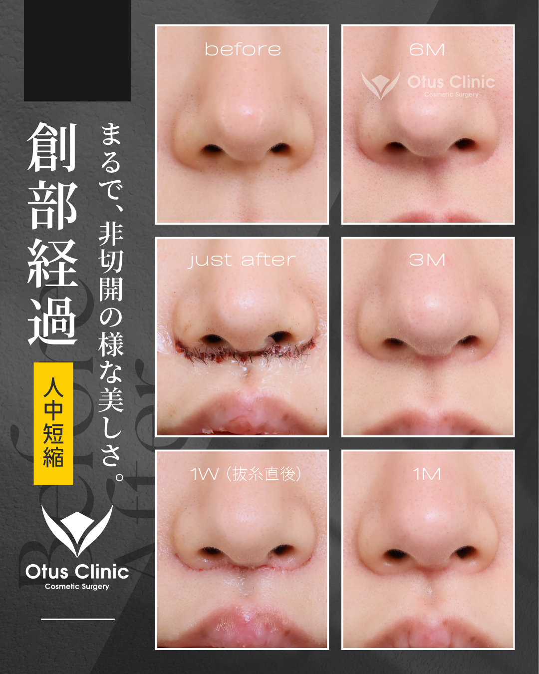 人中短縮（鼻下切開）