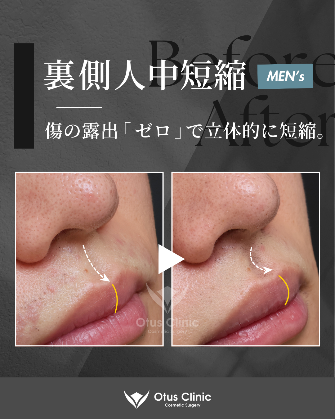 裏側人中短縮（切らない人中短縮）