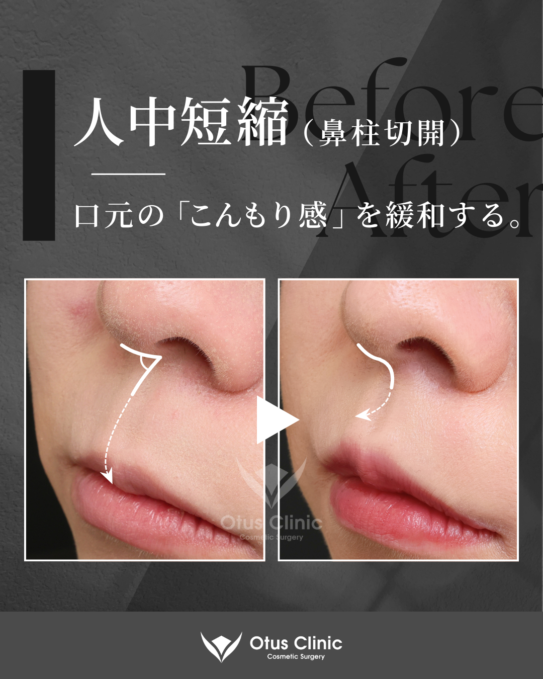 鼻柱切開人中短縮・口角挙上・外側人中短縮
