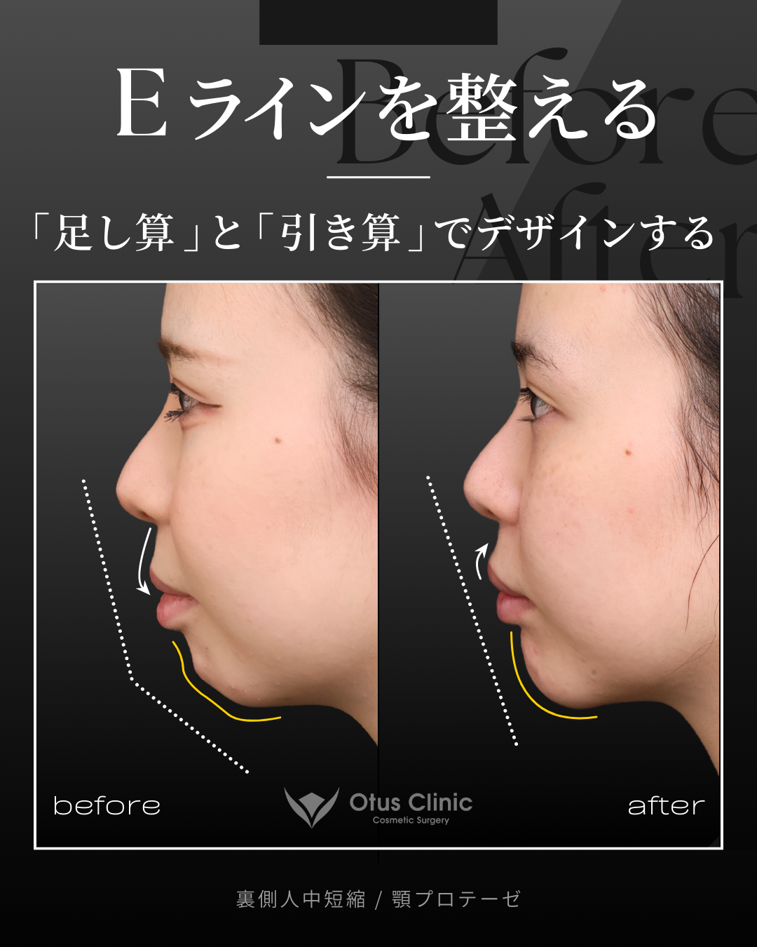 裏側人中短縮（切らない人中短縮）・顎プロテーゼ