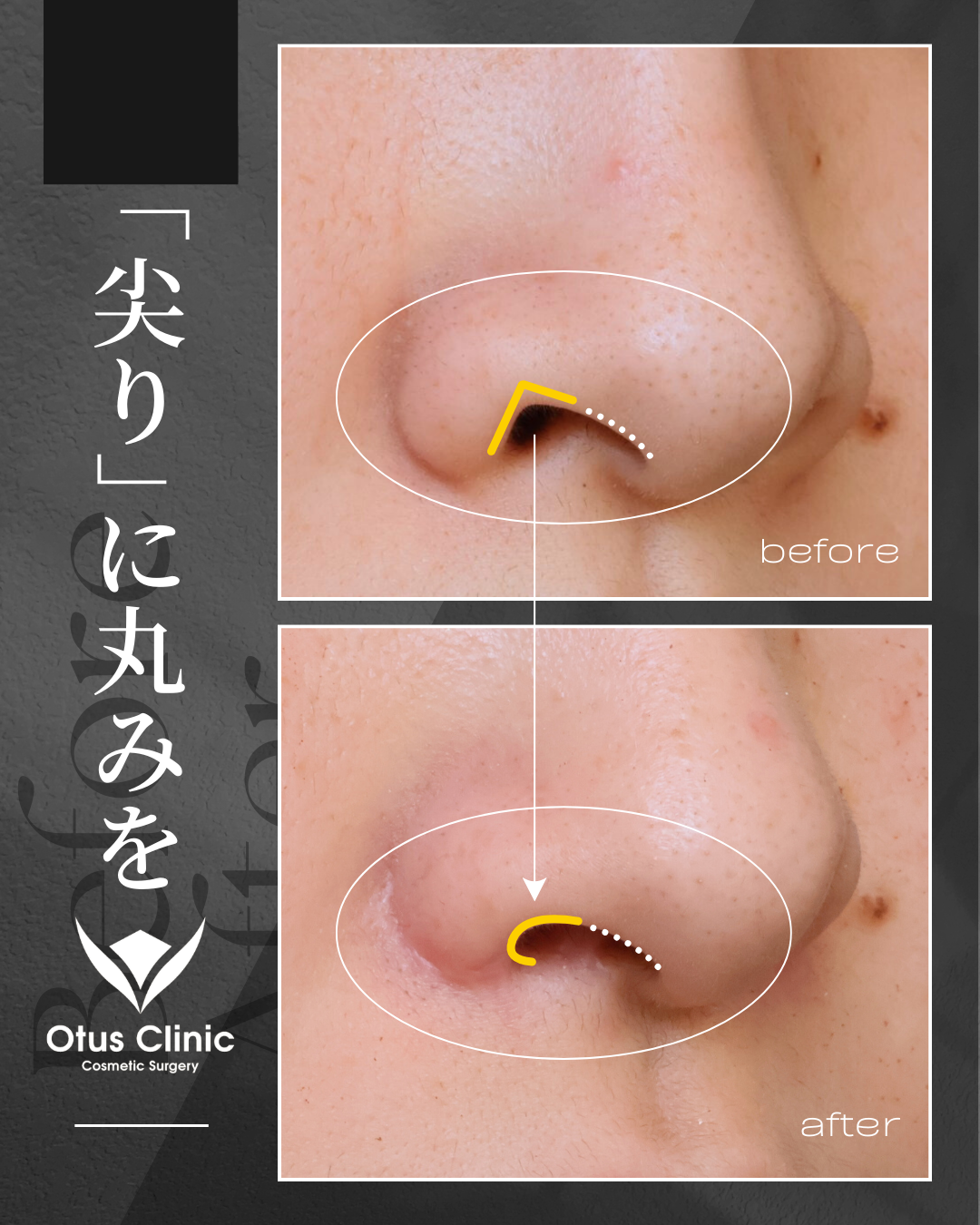 鼻翼縮小・鼻翼挙上・鼻孔縁挙上