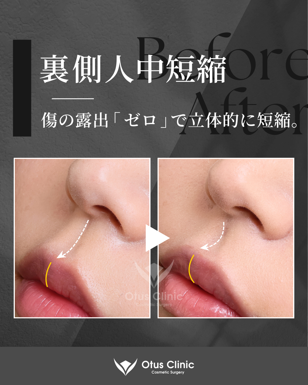 裏側人中短縮（切らない人中短縮）