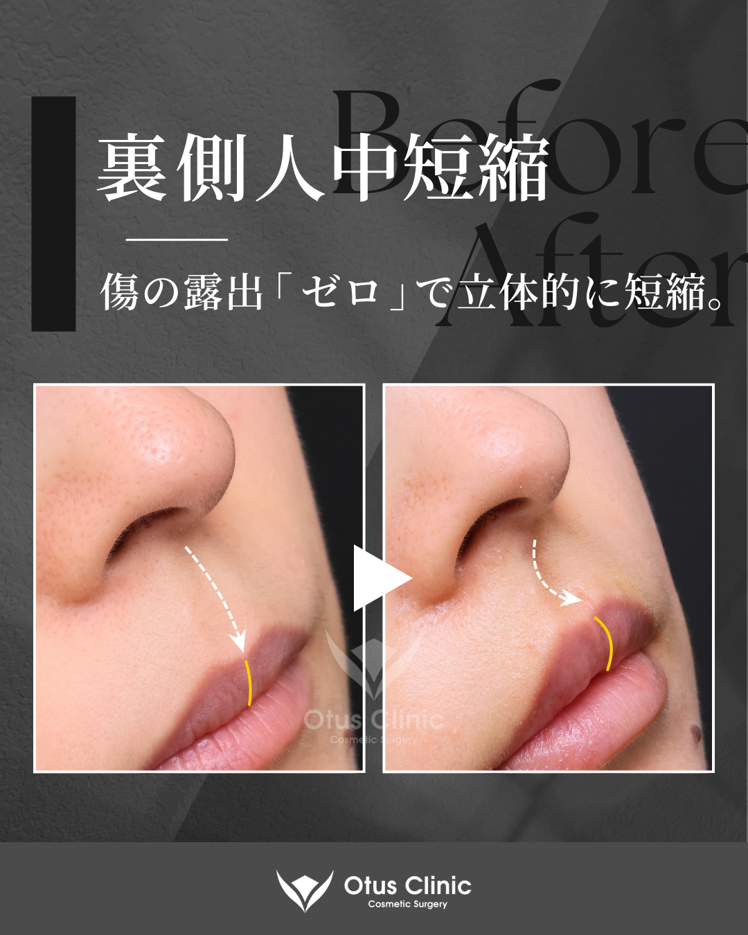 裏側人中短縮（切らない人中短縮）